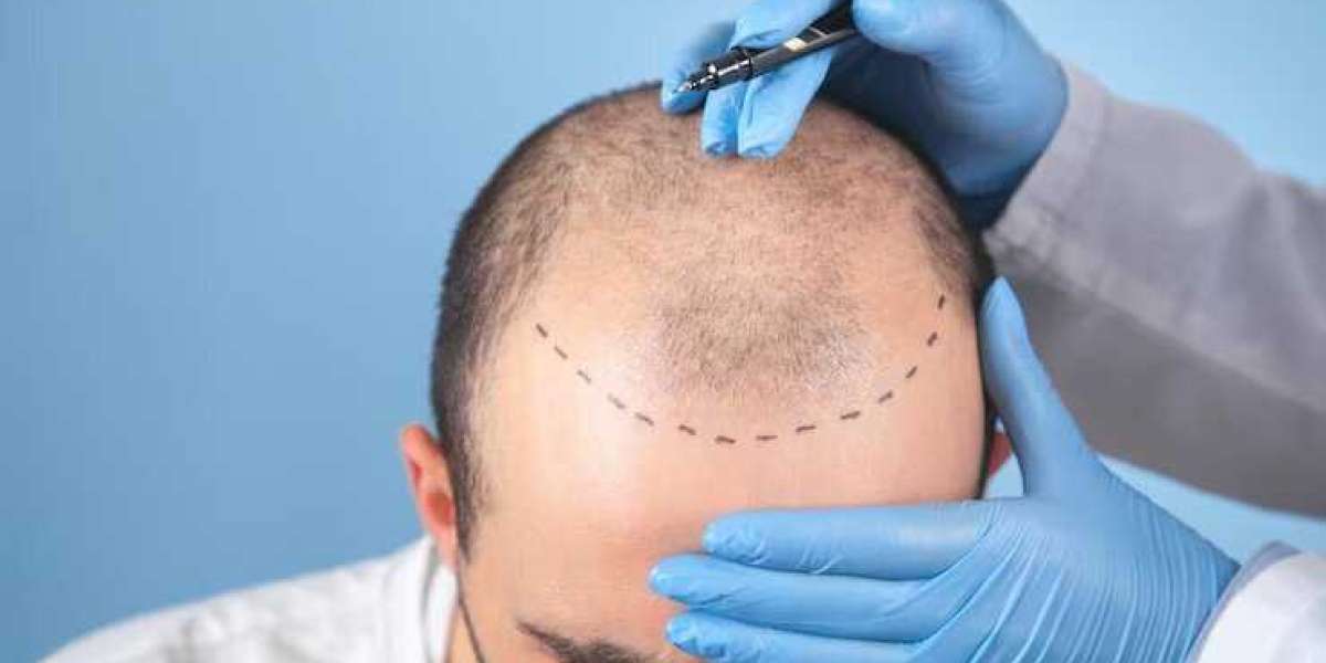 Best Fut hair transplant results in Beverly Hills