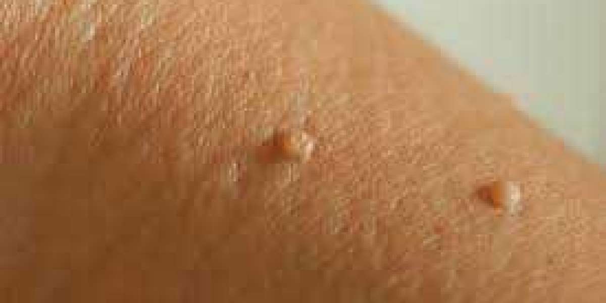 Top Five Common Prejudices About Defy Skin Tag Remover.