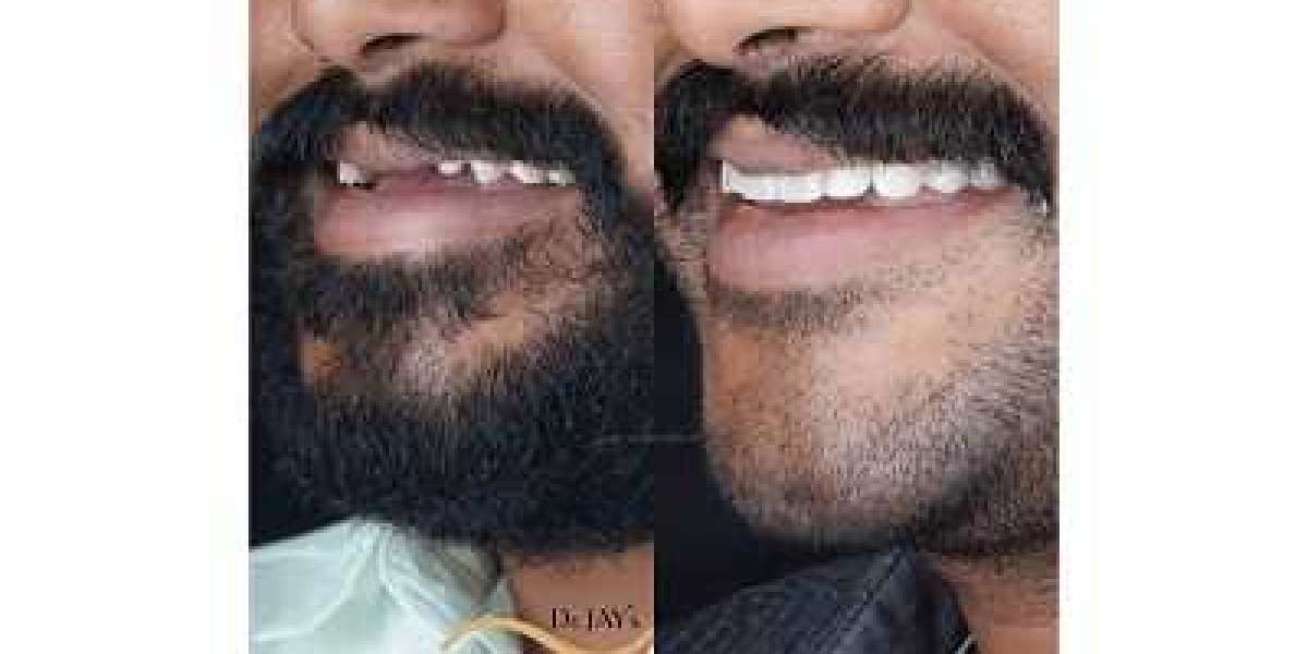 Revealing the Artistry of Smile Makeovers at Dr. JayDev Dental Clinic: Boosting Self-Assurance