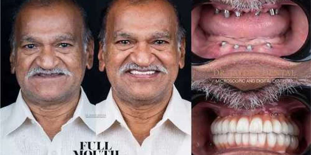 Discovering Complete Mouth Implants and Dental Implant Prices in India: Unlocking Smiles