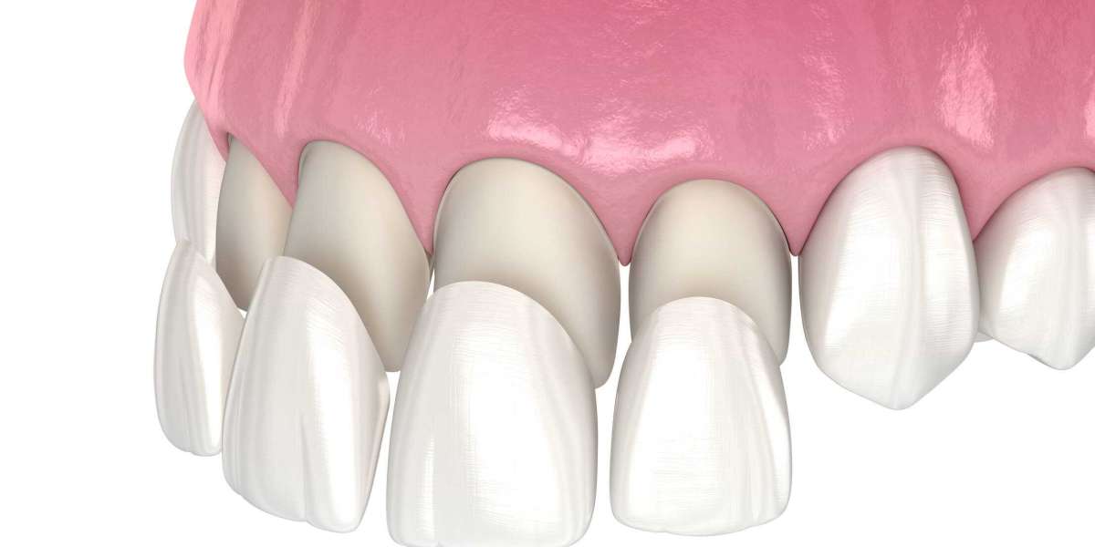 Dental Veneers Market Analysis, Opportunities, Forecast, Size, Competitive Analysis till 2028