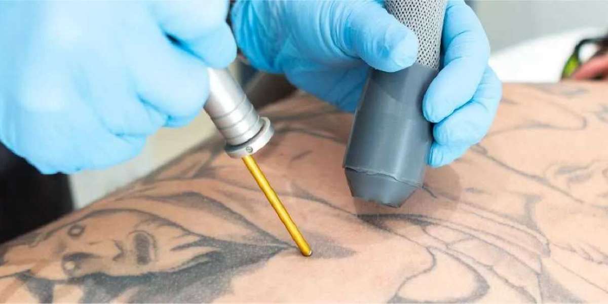 Tattoo Removal Market Goes Global: North America Leads, Asia-Pacific Surges (2024)