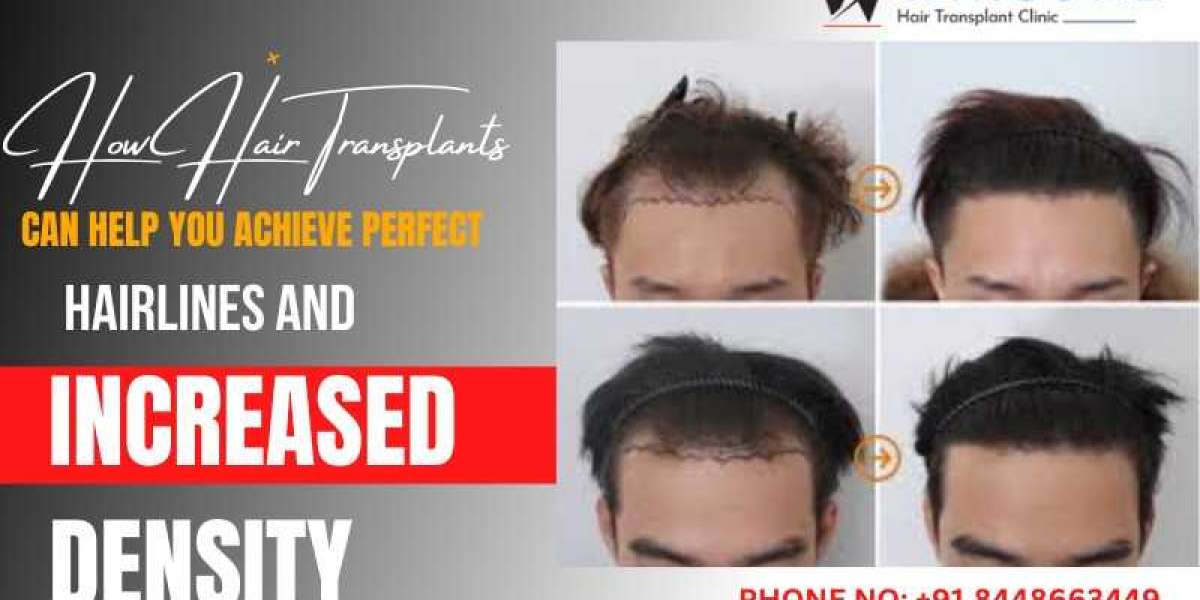 How Hair Transplants Can Help You Achieve Perfect Hairlines and Increased Density