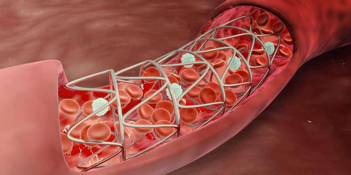 Coronary Stents Market: Global Information, Trends, Outlook, Analysis and Forecast